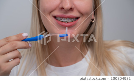 Caucasian woman cleaning her teeth with braces using a brush. Cropped portrait. Caucasian woman cleaning her teeth with braces using a brush. Cropped portrait. 100804981