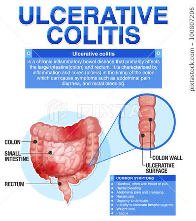 Ulcerative Colitis Symptoms Infographic Ulcerative Colitis Symptoms Infographic 100807208