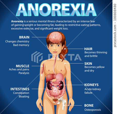 Informative poster of Anorexia eating disorder 100808480