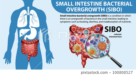 Small Intestine Bacterial Overgrowth (SIBO) 100808527