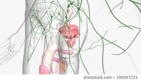 Stage II testicular cancer is characterized by the spread of cancer to nearby regional lymph nodes. 100847131