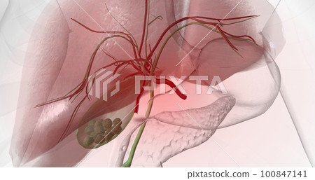 Gallstones are pieces of solid material that form in the gallbladder, a small hollow organ located beneath the liver. Gallstones are pieces of solid material that form in the gallbladder, a small hollow organ located beneath the liver. 100847141