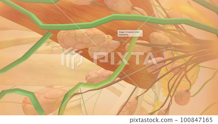Stage I breast tumors are invasive and have started to spread to the fatty breast tissue or to nearby lymph nodes. Stage I breast tumors are invasive and have started to spread to the fatty breast tissue or to nearby lymph nodes. 100847165