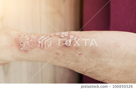 Acute psoriasis on the legs Acute psoriasis on the legs 100850326
