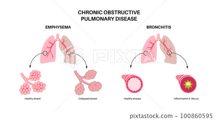 Chronic obstructive pulmonary disease Chronic obstructive pulmonary disease 100860595