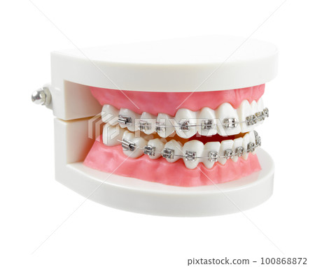 The Teeth model with metal wire dental braces or dental instruments isolated on white background, Save clipping path. 100868872