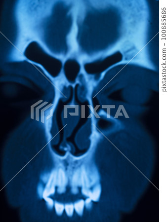 Xray scan skull nose Xray scan skull nose 100885686