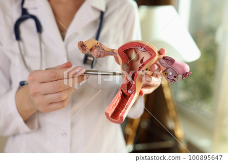 Gynecologist demonstrates uterus model in hospital office 100895647