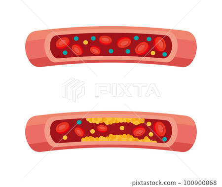 Image illustration of blood vessel cholesterol 100900068