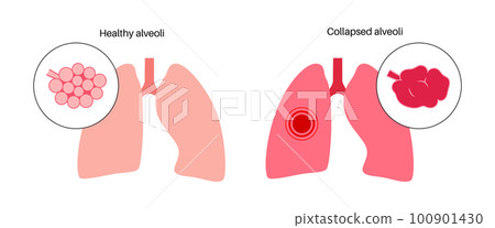 Emphysema anatomical poster 100901430