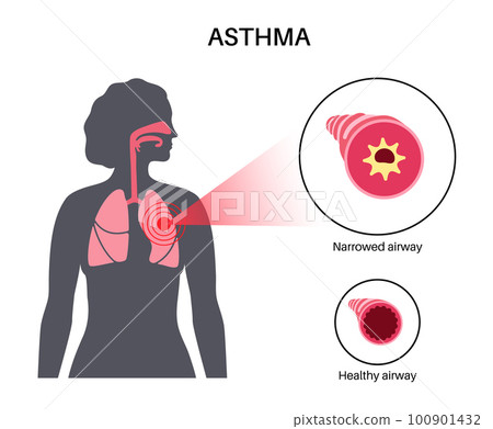 Asthma lung disease 100901432