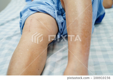 Asian elderly woman patient with scar knee replacement surgery in hospital. 100910156