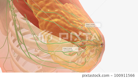 Stage 0 breast tumors are in situ; they remain in the area in which they originated and show no signs of spreading to nearby tissues. Stage 0 breast tumors are in situ; they remain in the area in which they originated and show no signs of spreading to nearby tissues. 100911566
