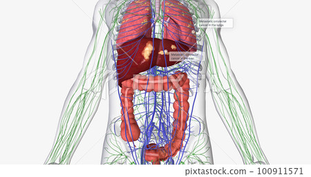 Colorectal cancer (CRC) is a common colon or rectal cancer that affects many patients over middle age. 100911571