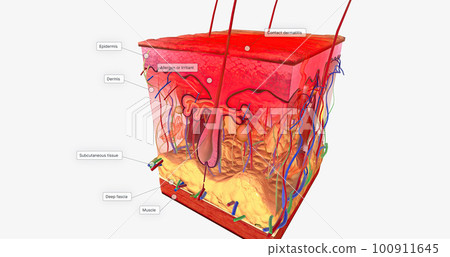 Contact Dermatitis in Skin Tissue 100911645
