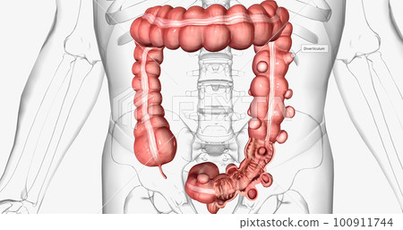 Diverticulosis is a condition characterized by the formation of diverticula in the walls of the intestines. 100911744