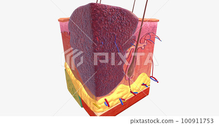 Basal Cell Carcinoma in Tissue, Stage II 100911753