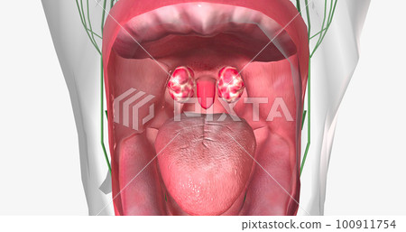 Strep throat is a common condition caused by a bacterial infection of the mouth and back of the oral cavity. Strep throat is a common condition caused by a bacterial infection of the mouth and back of the oral cavity. 100911754