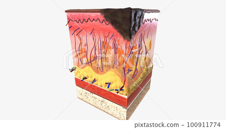 The In Stage II ALM Acral Lentiginous Melanoma 100911774