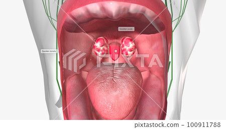 Strep throat is a common condition caused by a bacterial infection of the mouth and back of the oral cavity. 100911788
