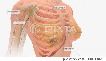 Stage IV breast tumors are invasive and have spread beyond the localized area to the lungs, bones, liver, brain, or to distant lymph nodes. 100911825