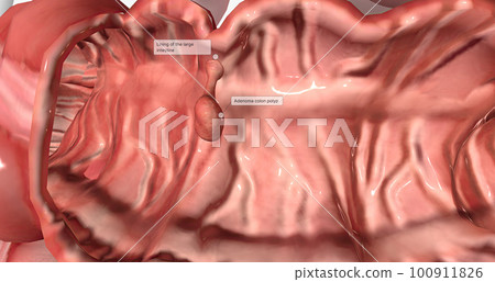 Adenomatous polyps are gland-like growths that develop on the mucous membrane lining the large intestine. 100911826