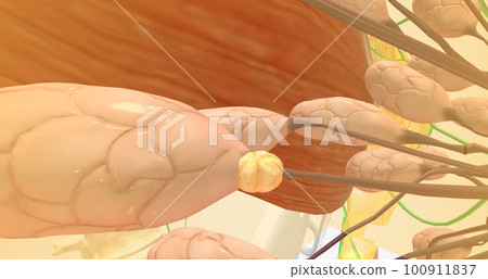 Stage I breast tumors are invasive and have started to spread to the fatty breast tissue or to nearby lymph nodes. Stage I breast tumors are invasive and have started to spread to the fatty breast tissue or to nearby lymph nodes. 100911837