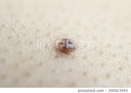 Two hairs growing from an Asian mole 100923943