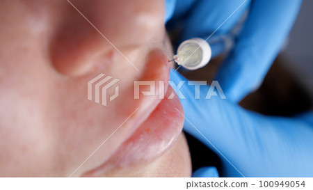 close-up, female face. Surgeon, in medical gloves, carefully and slowly injects hyaluronic acid into woman's lips with a syringe. lip augmentation procedure. beauty injections. Plastic surgery. close-up, female face. Surgeon, in medical gloves, carefully and slowly injects hyaluronic acid into woman's lips with a syringe. lip augmentation procedure. beauty injections. Plastic surgery. 100949054