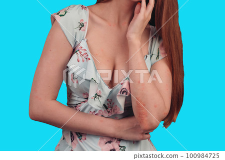 Unrecognizable young woman suffering from autoimmune incurable dermatological skin disease called psoriasis. Large red, inflamed, flaky rash on elbows. Joints affected by psoriatic arthritis 100984725