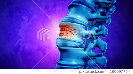 Traumatic Spine Fracture Traumatic Spine Fracture 100997704