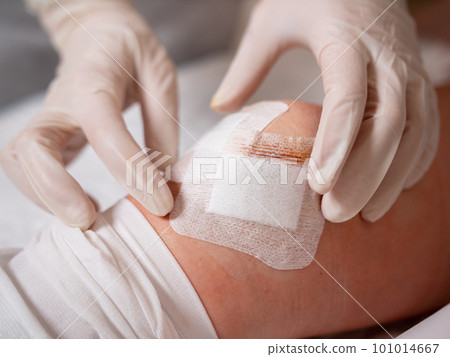 Close-up of female hands of a nurse in sterile gloves at the knee of a patient after arthroscopy surgery. Close-up of female hands of a nurse in sterile gloves at the knee of a patient after arthroscopy surgery. 101014667
