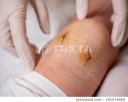 The nurse's gloved hands probe the knee joint with medical stitches after arthroscopy The nurse's gloved hands probe the knee joint with medical stitches after arthroscopy 101014668