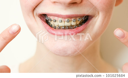 Close-up portrait of a young woman pointing at a smile with braces on her teeth. 101025684
