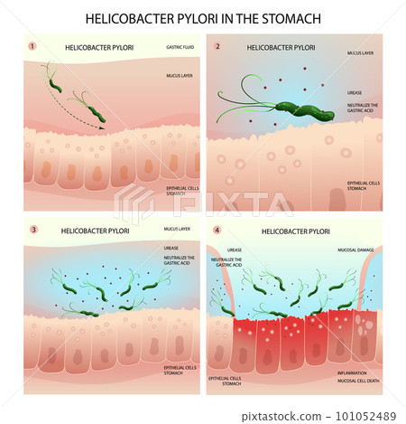 Helicobacter pylori infection process in human stomach 101052489