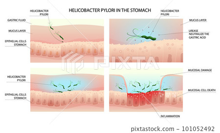 Helicobacter pylori infection process in human stomach with gastritis 101052492