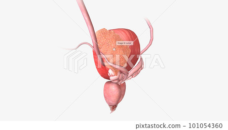 The Bladder Cancer, Stage III The Bladder Cancer, Stage III 101054360