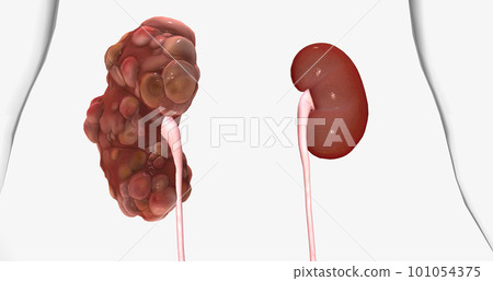 Polycystic kidney disease (PKD) is an inherited disorder of the kidneys. Polycystic kidney disease (PKD) is an inherited disorder of the kidneys. 101054375