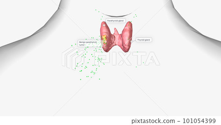 Hyperparathyroidism is a condition in which high amounts of parathyroid hormone are produced by the parathyroid gland. 101054399
