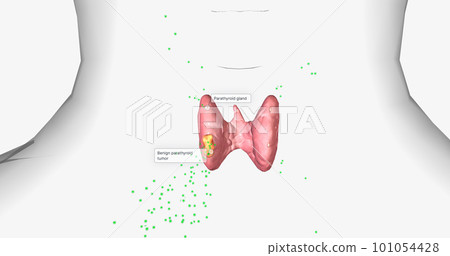 Hyperparathyroidism is a condition in which high amounts of parathyroid hormone are produced by the parathyroid gland. 101054428