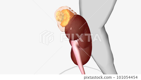 An adrenal incidentaloma is a solid mass in one or both adrenal glands. 101054454