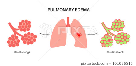 Pulmonary edema disease 101056515