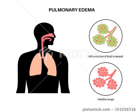 Pulmonary edema disease 101056516