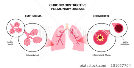 Chronic obstructive pulmonary disease 101057794