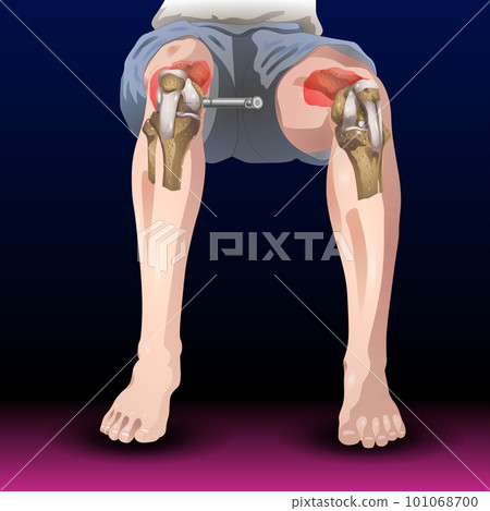 Bones Pain, Injury and Inflammation, Knee Joint Pain Silhouette Icon Ache of Knee, Leg Skeleton, Arthritis, Osteoporosis and Bones Joint, Illustration Bones Pain, Injury and Inflammation, Knee Joint Pain Silhouette Icon Ache of Knee, Leg Skeleton, Arthritis, Osteoporosis and Bones Joint, Illustration 101068700