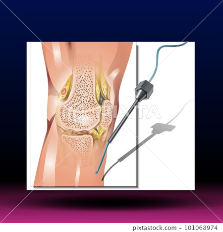 Knee synovial fluid - articular cartilage, joint cavity, muscle and tendon, Isolated vector illustration on white Knee synovial fluid - articular cartilage, joint cavity, muscle and tendon, Isolated vector illustration on white 101068974