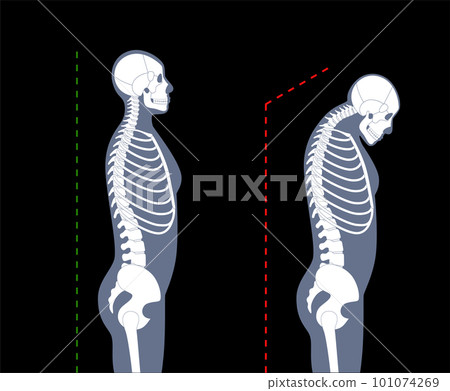 Neck vertebrae deformity 101074269