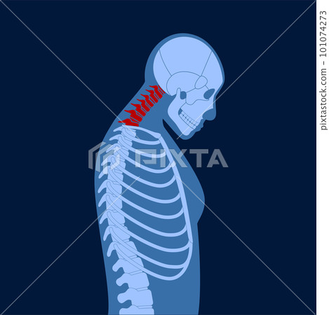 Neck vertebrae deformity Neck vertebrae deformity 101074273