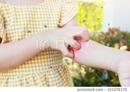 Little girl has skin rash allergy and itchy on her arm from mosquito bite Little girl has skin rash allergy and itchy on her arm from mosquito bite 101076178