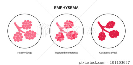 Emphysema anatomical poster Emphysema anatomical poster 101103637